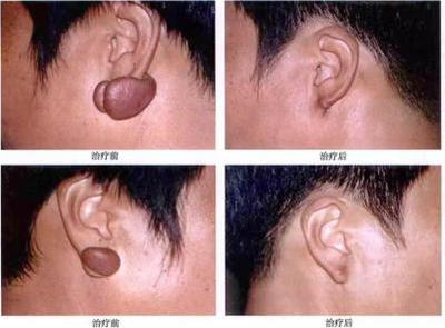 跟瘢痕疙瘩、皮膚血管瘤說拜拜--放射性核素敷貼治療